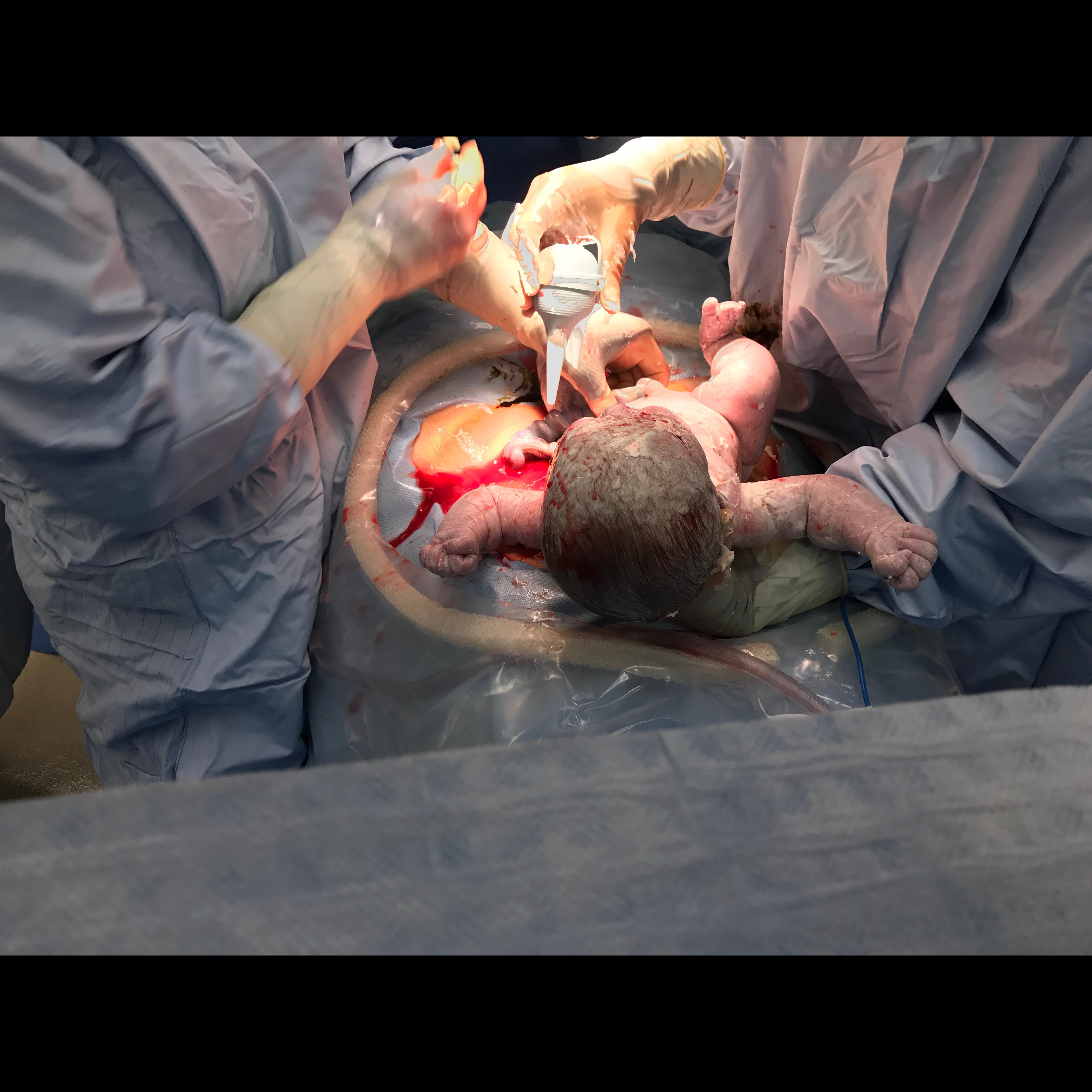 Trusted Caesarean Section Services in Chennai When... main image