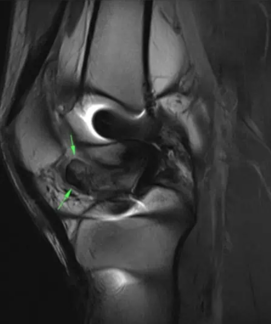 Loss of extension after ACL surgery: How to ass... main image