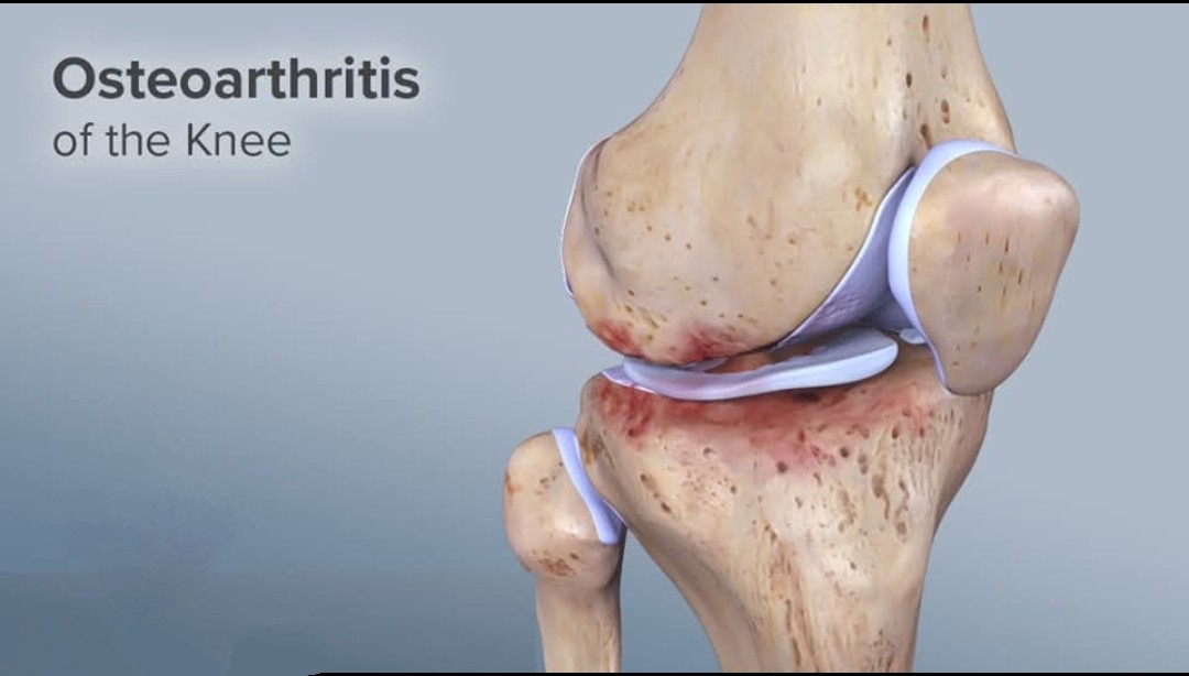 Osteoarthritis Osteoarthritis (OA) is most common ... main image