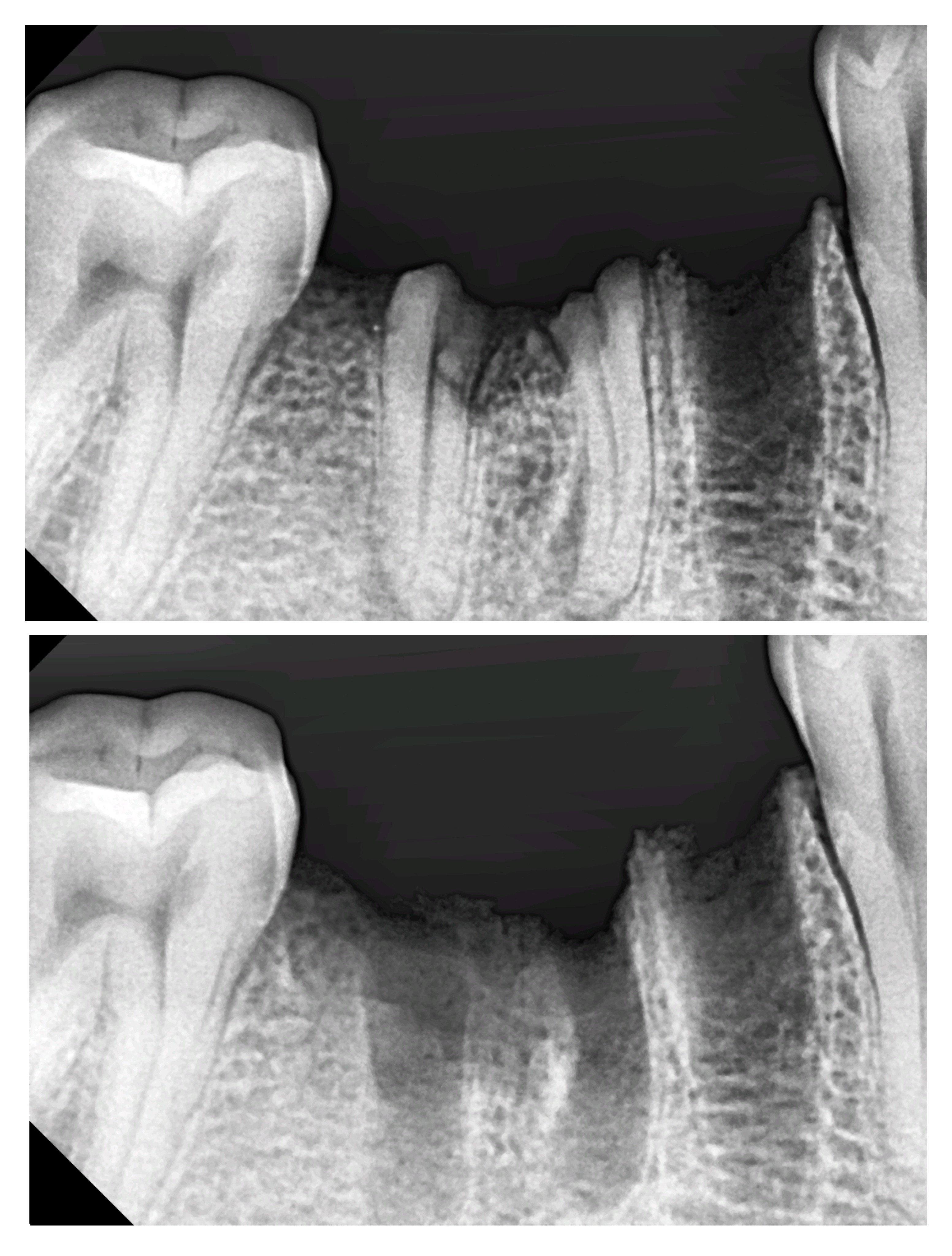 Decayed tooth removal near me Painless extracti... main image