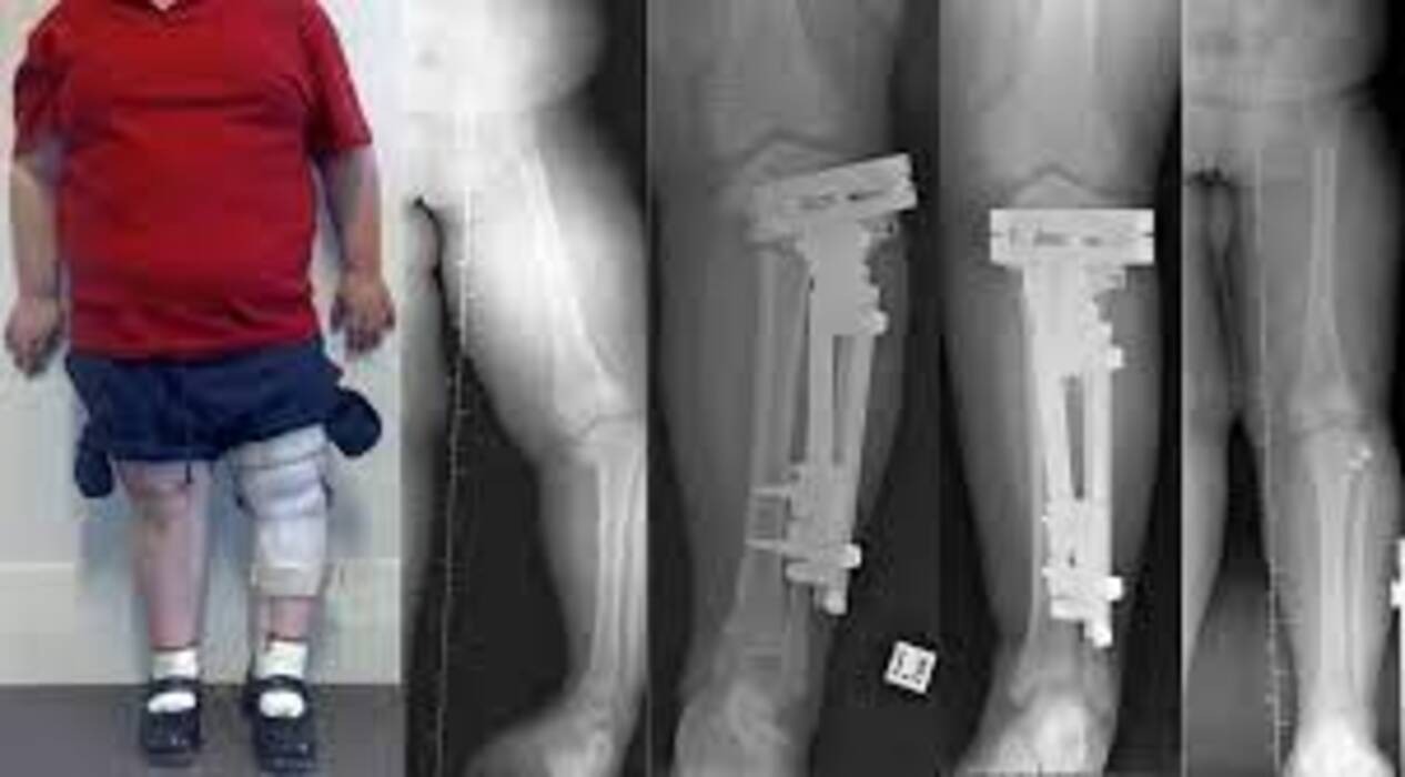 Deformity Correction in Pune - Restoring Alignm... main image