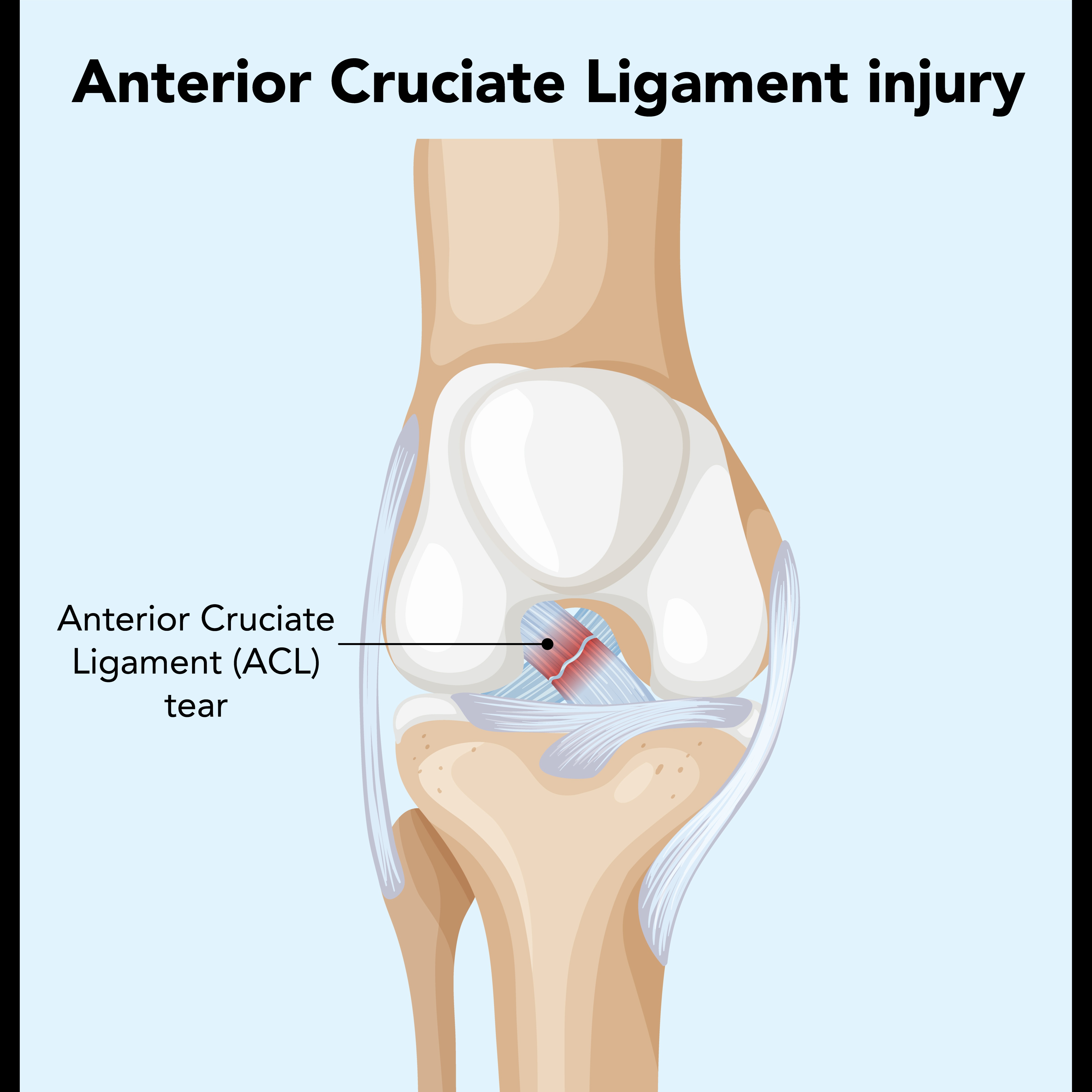 ACL Tear Treatment In New Delhi – Get Back To M... main image