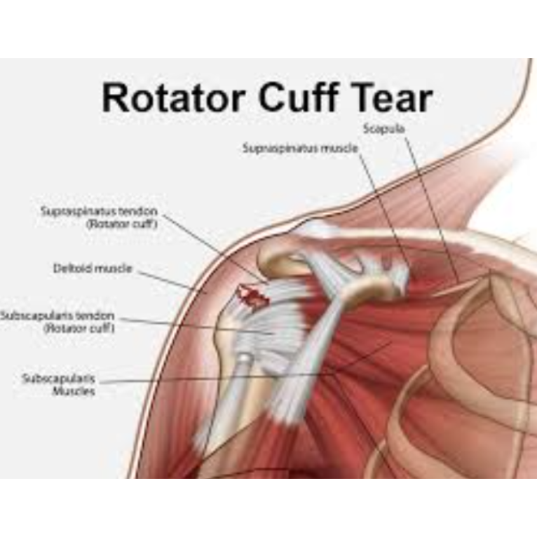 Comprehensive Care for Rotator Cuff Tear in Nag... main image