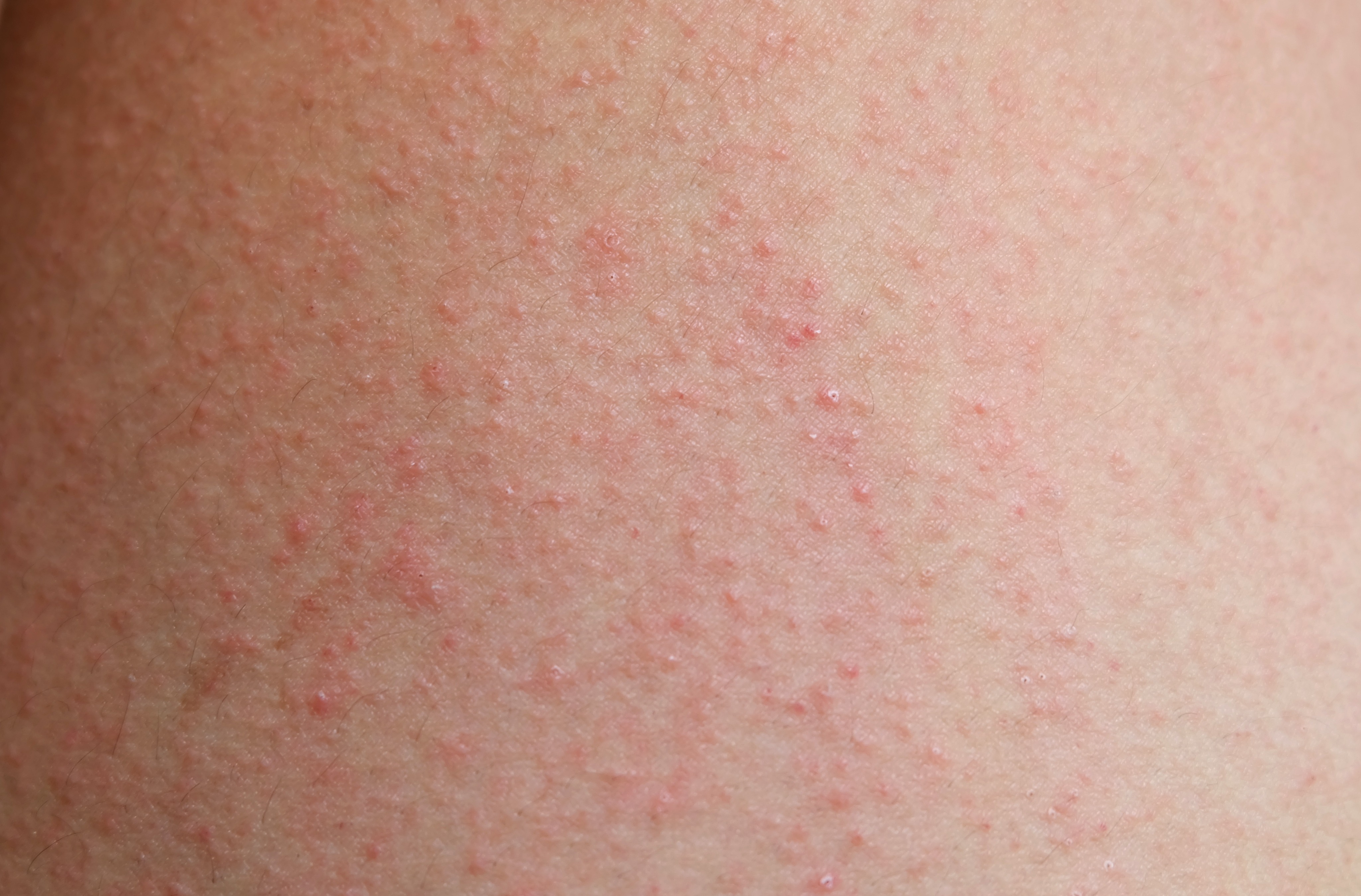 Ayurvedic Treatment for Keratosis Pilaris in Pune ... main image