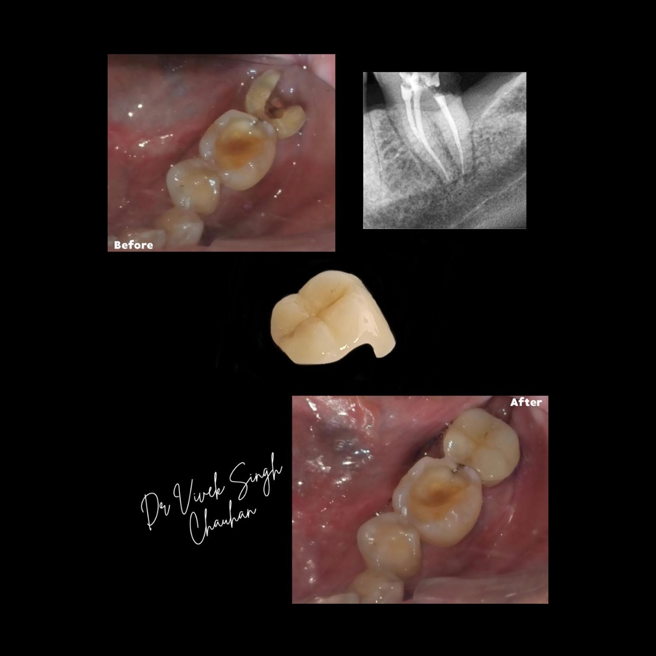 Before and after | molar onlay restoration.This ro... main image