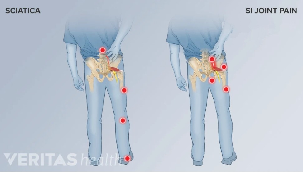 Sacroiliitis and sciatica may have similar symptom... main image
