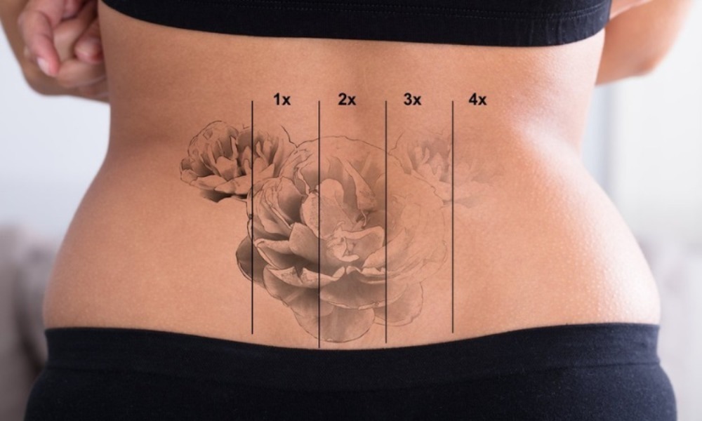 Tattoo Removal in Chennai Finesse Aesthetic provid... main image
