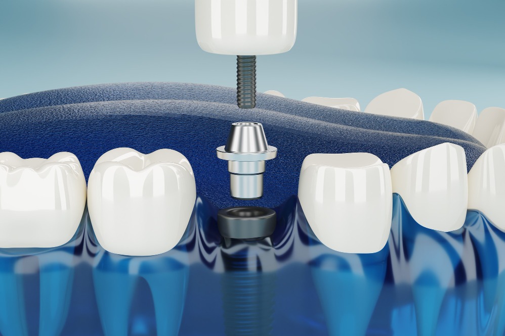 Dental Implant Treatment in Nagpur – Restore Fu... main image