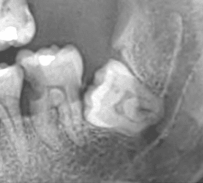 Wisdom Tooth Removal in Delhi – Don't Wait Unti... main image