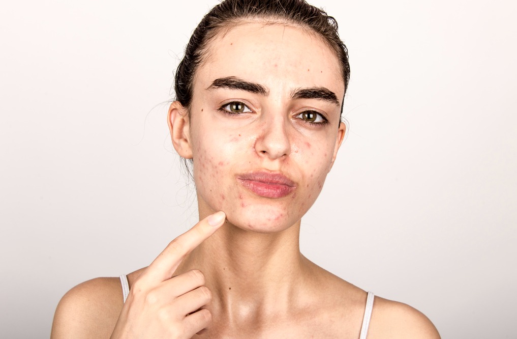 Ayurvedic Treatment for Spots on Face in Pune –... main image