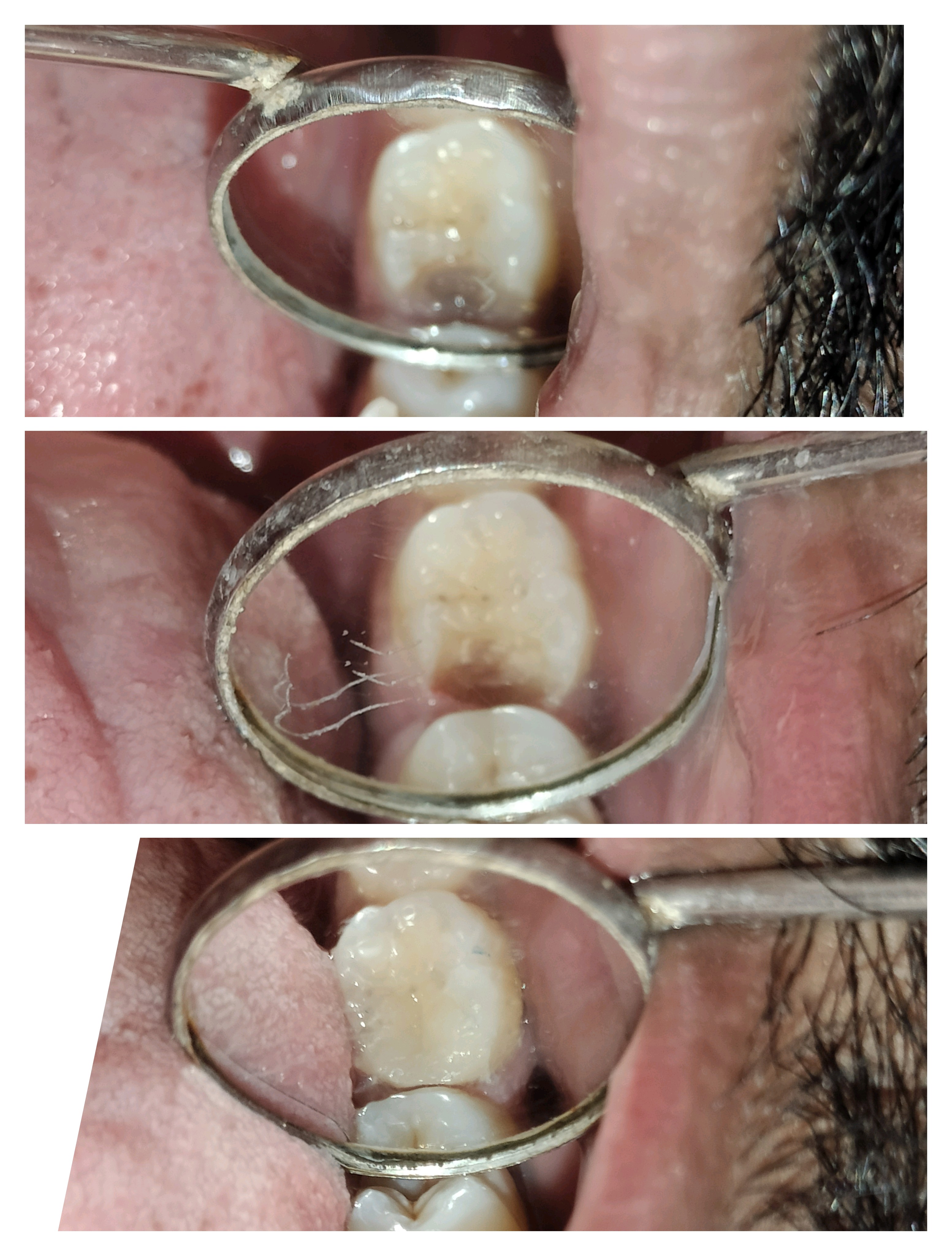 Teeth filling near me Teeth filling dentist in ... main image