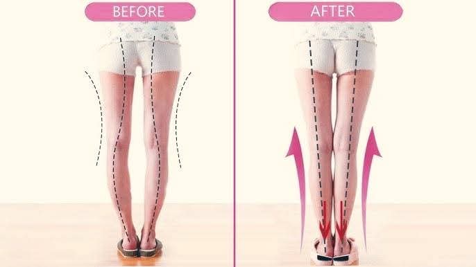 #Bowed_Leg in adult Bowlegs in adults, also kno... main image