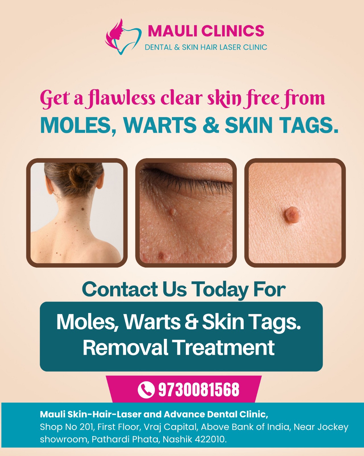 Best WART , TAG , MOLE Removal Treatment In Nashik... main image