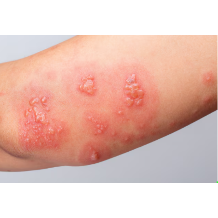 Ayurvedic Treatment for Scabies in Pune – Clean... main image