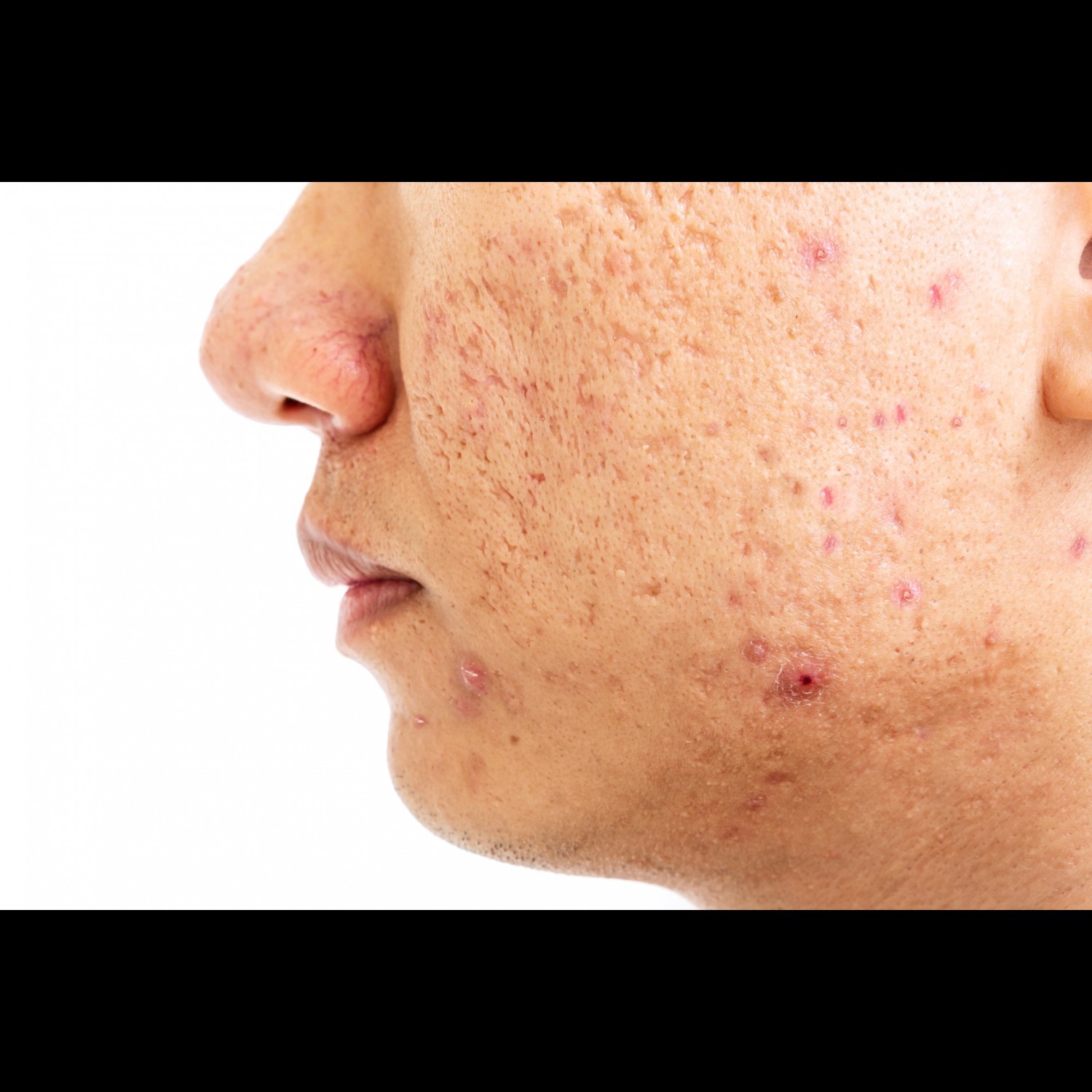 Acne Scar Removal in Nashik – Clear Skin Without M... main image