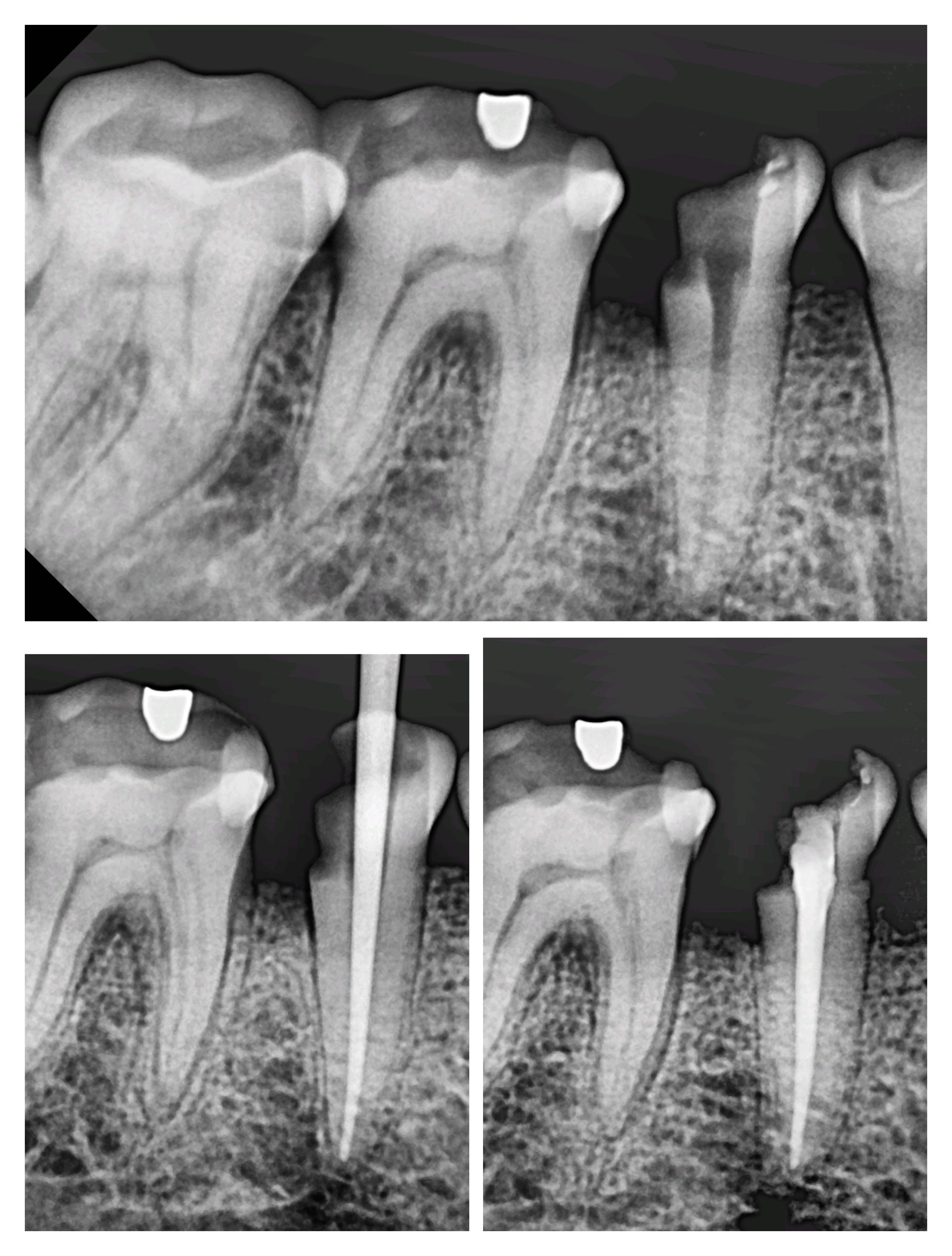 Root canal treatment in Mira Road East Urgent r... main image