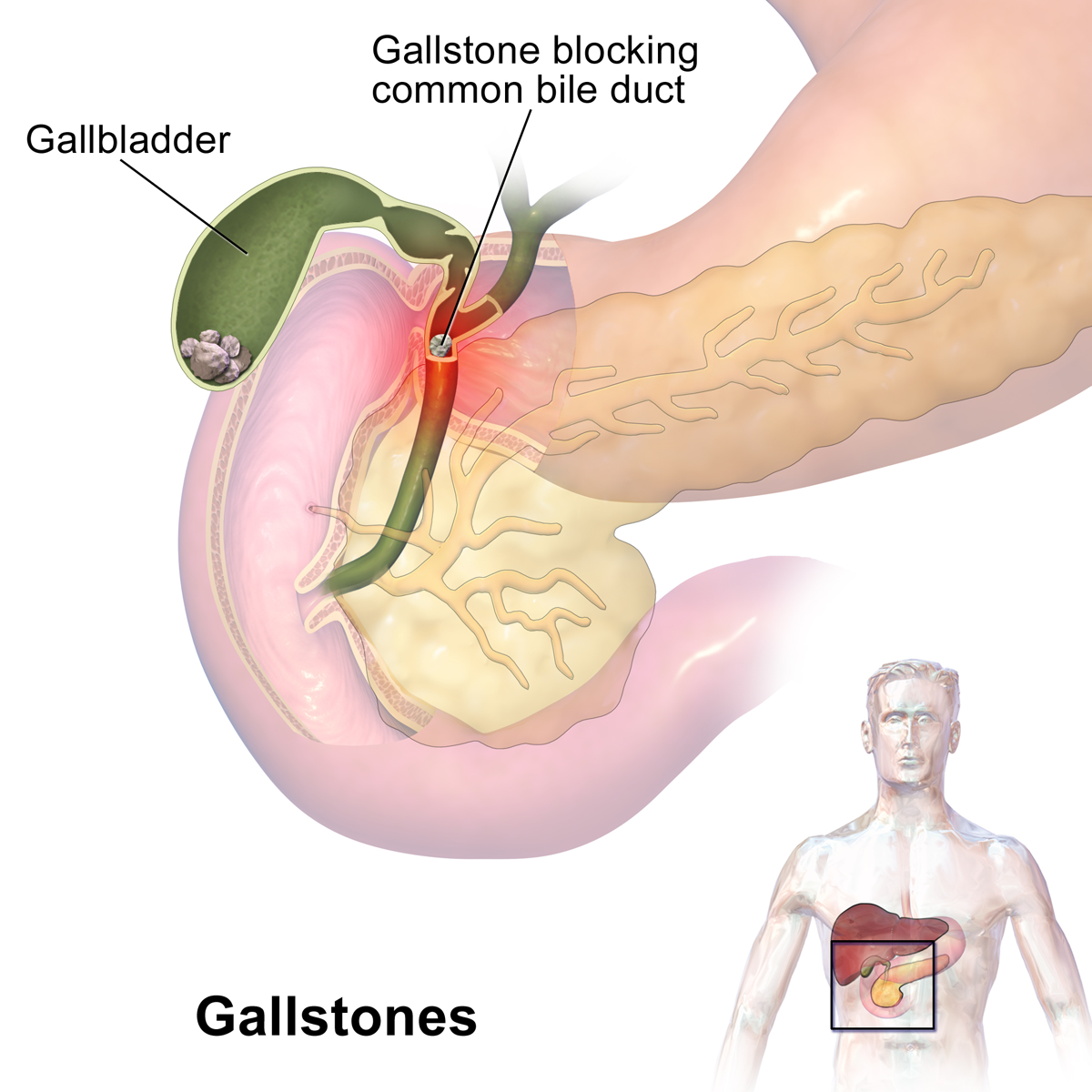 Gall Bladder Stone Treatment in Nashik (Ayurvedic ... main image