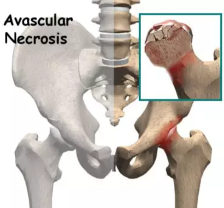 Avascular Necrosis Care in Nagpur to Prevent Jo... main image