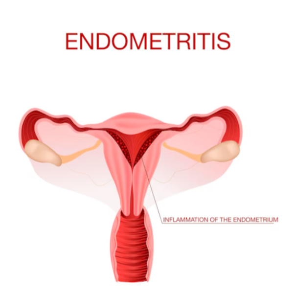 Endometriosis Treatment Care in Pune – Supporti... main image