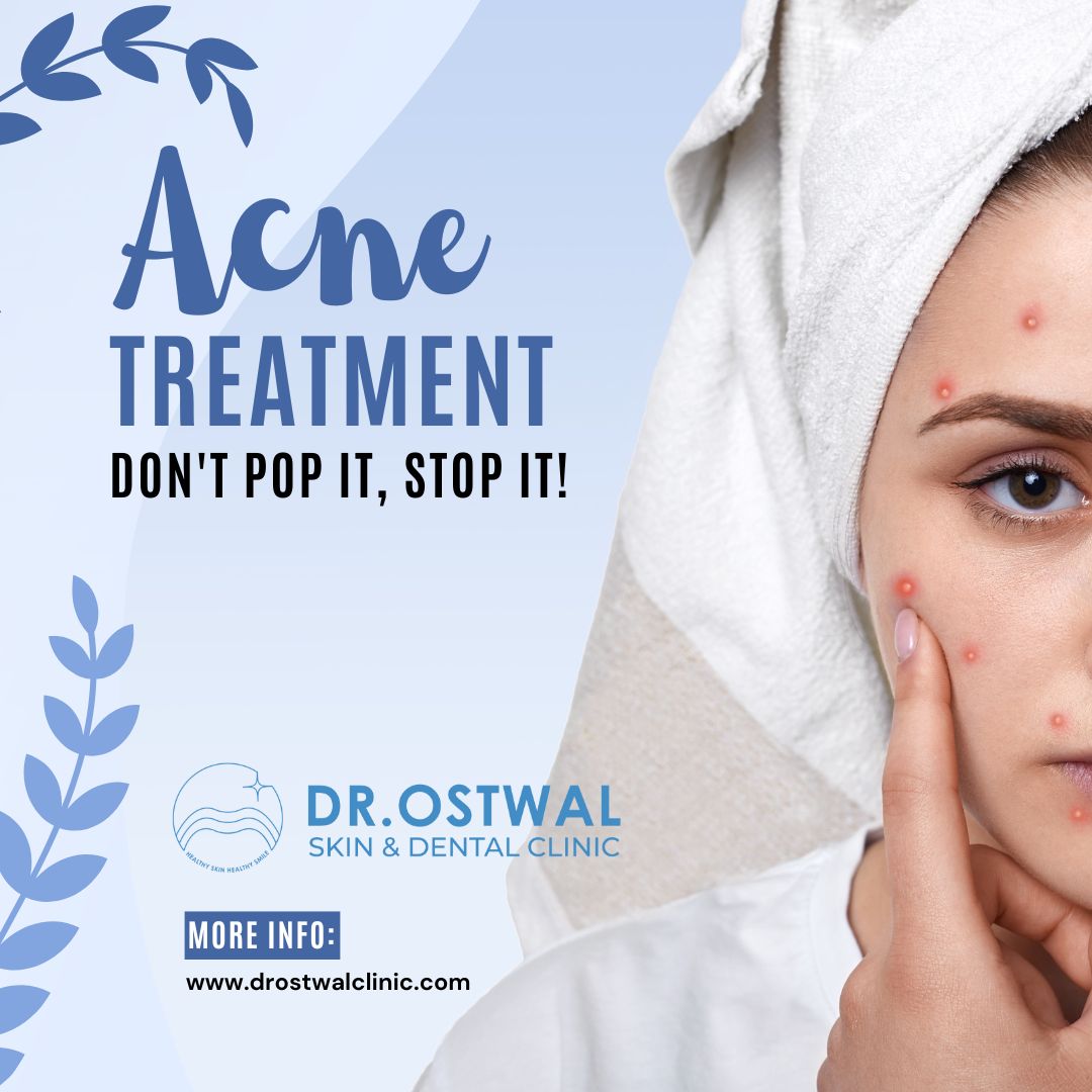 🌟 Acne: Causes, Types & Treatment | Dr. Ostwal ... main image