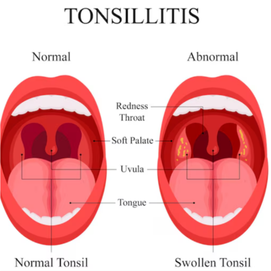 Tonsillitis Treatment for Kids in Jaipur with Gent... main image