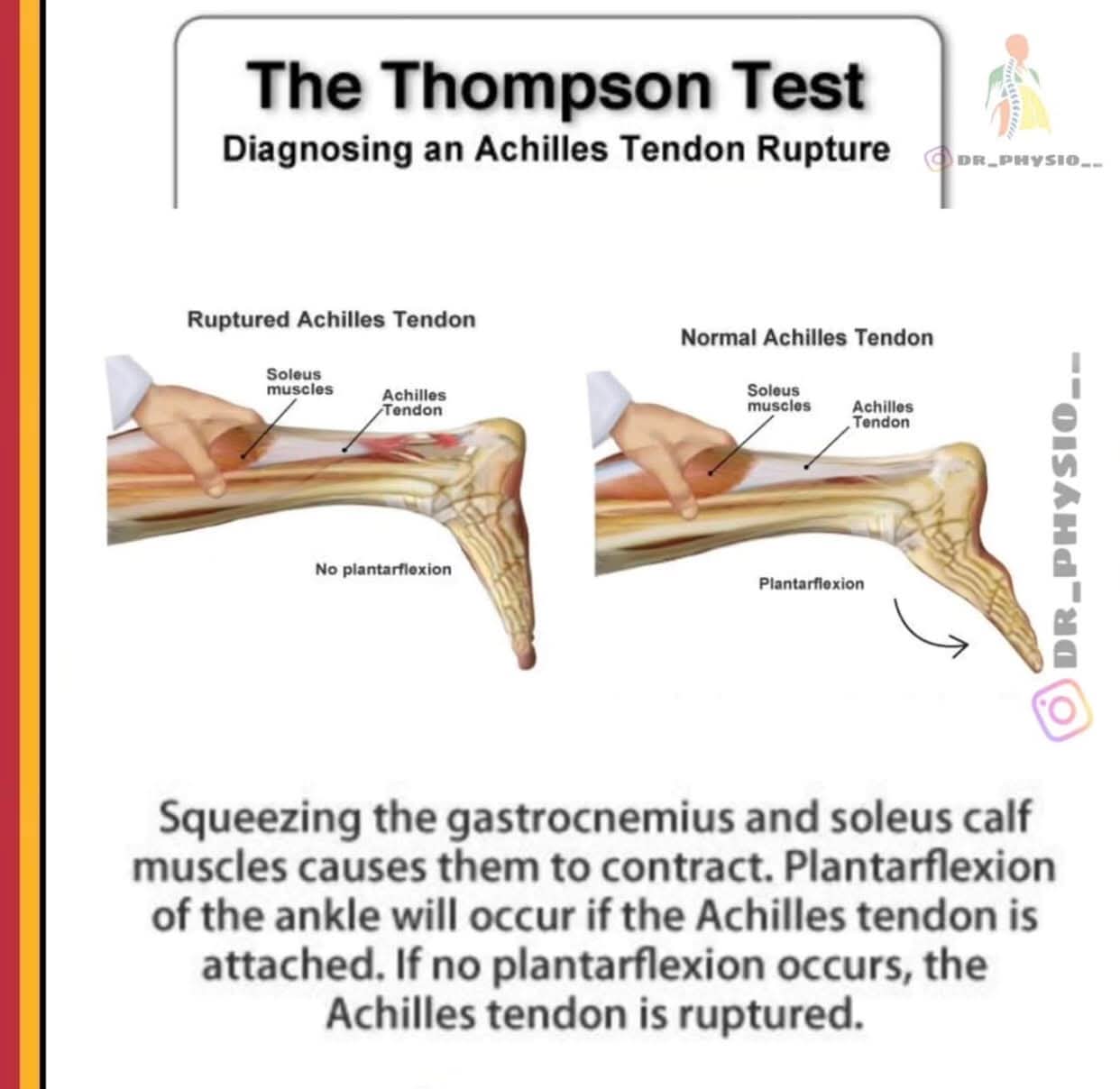 Achilles Tendon Tear Treatment at Sunshine Super S... main image