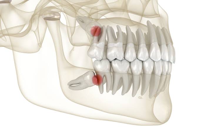 Wisdom Tooth Removal in Mira Road East Thane wi... main image