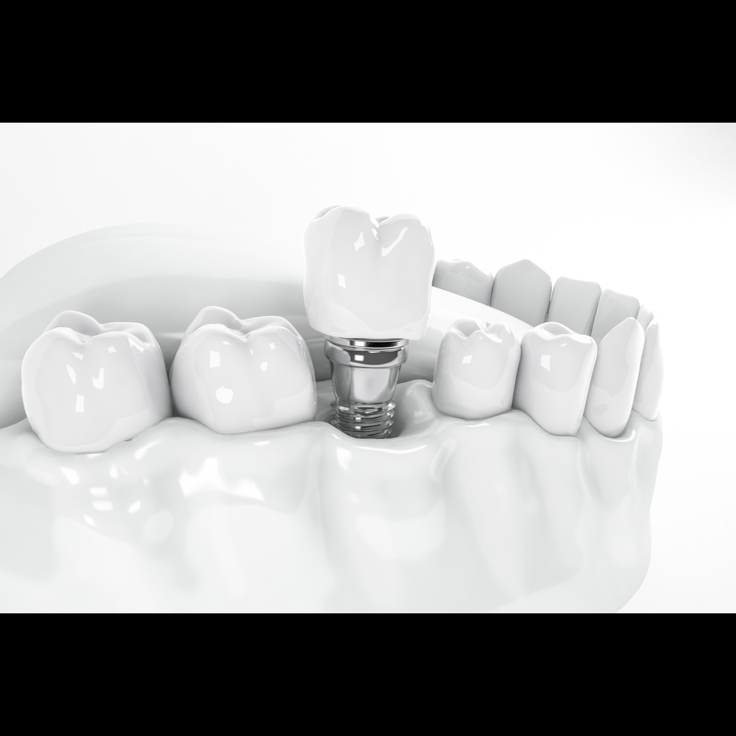 Dental Implants in Vikaspuri – Best Replacement for Missing Te... main image