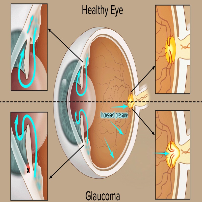 Glaucoma Treatment in Nagpur – Early Diagnosis Can Save Your Vis... main image
