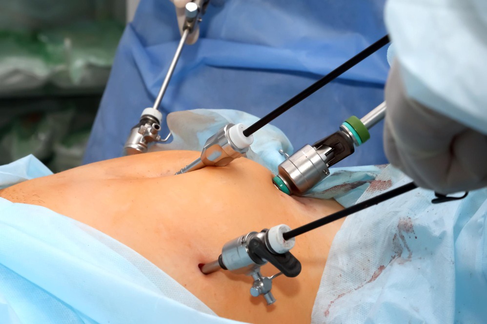 Laparoscopic Sterilization Services in Chennai main image