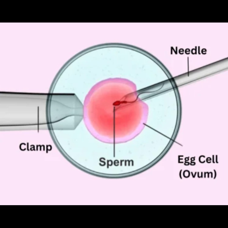 ICSI Treatment in Chennai – Overcoming Male Infertility with Precis... main image