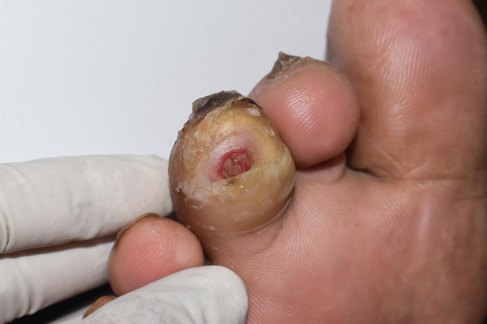 Gangrene Treatment in Dombivli by Dr.Tejas Savdekar / Dr.Hemant Pat... main image