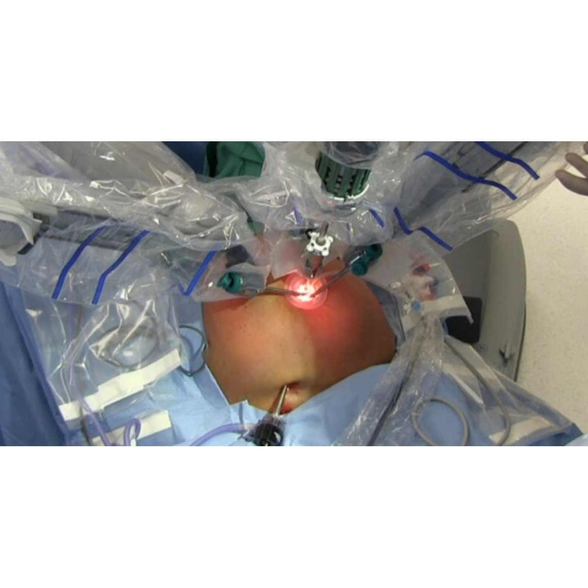 Advanced Robotic Gallbladder Surgery Near Dasarahalli – Gentle and Precise C... main image