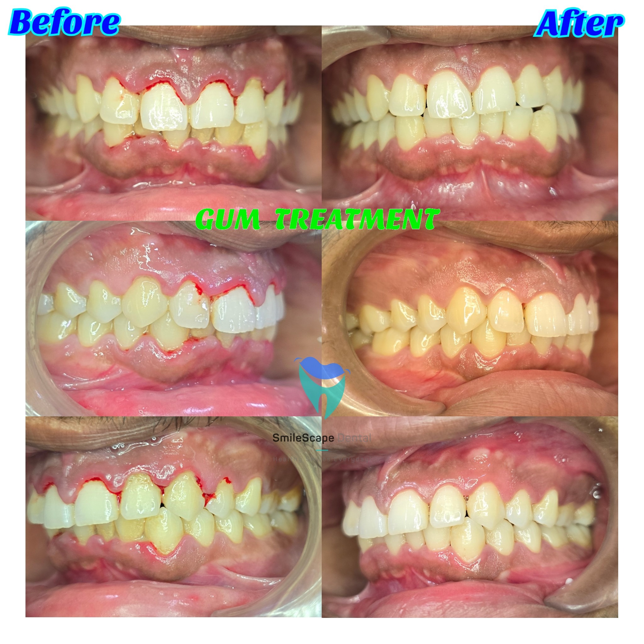 Bleeding gums is the first sign of gum problems. Frequently bleeding gums are suggestive of chrnic g... main image