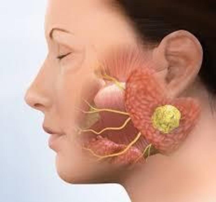 Parotid Surgery in Dwarka – Trusted Solutions for Facial Swelling or Mas... main image