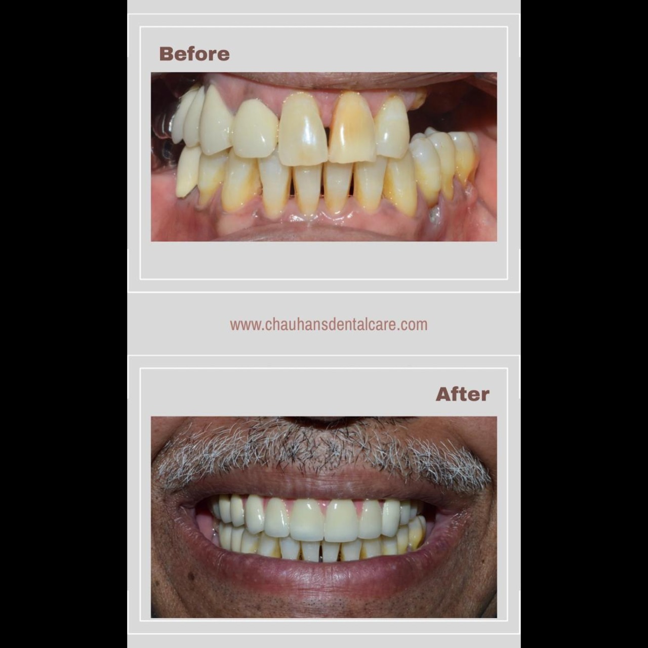 Full Mouth Rehabilitation
From missing teeth to a confident smile.
Upper arch: Implants + implant-su... main image