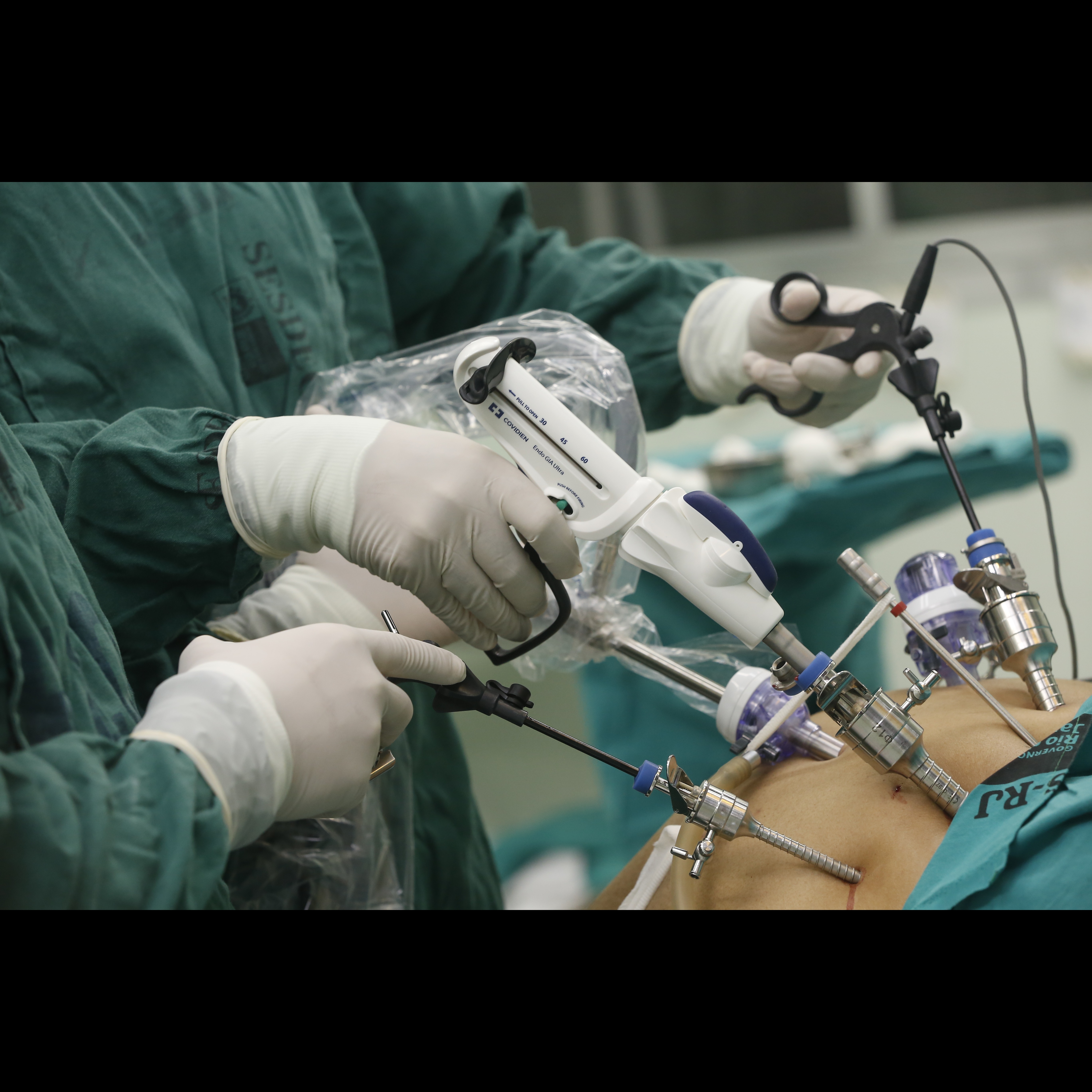 Laparoscopic Procedures for Appendicitis in Chen... main image