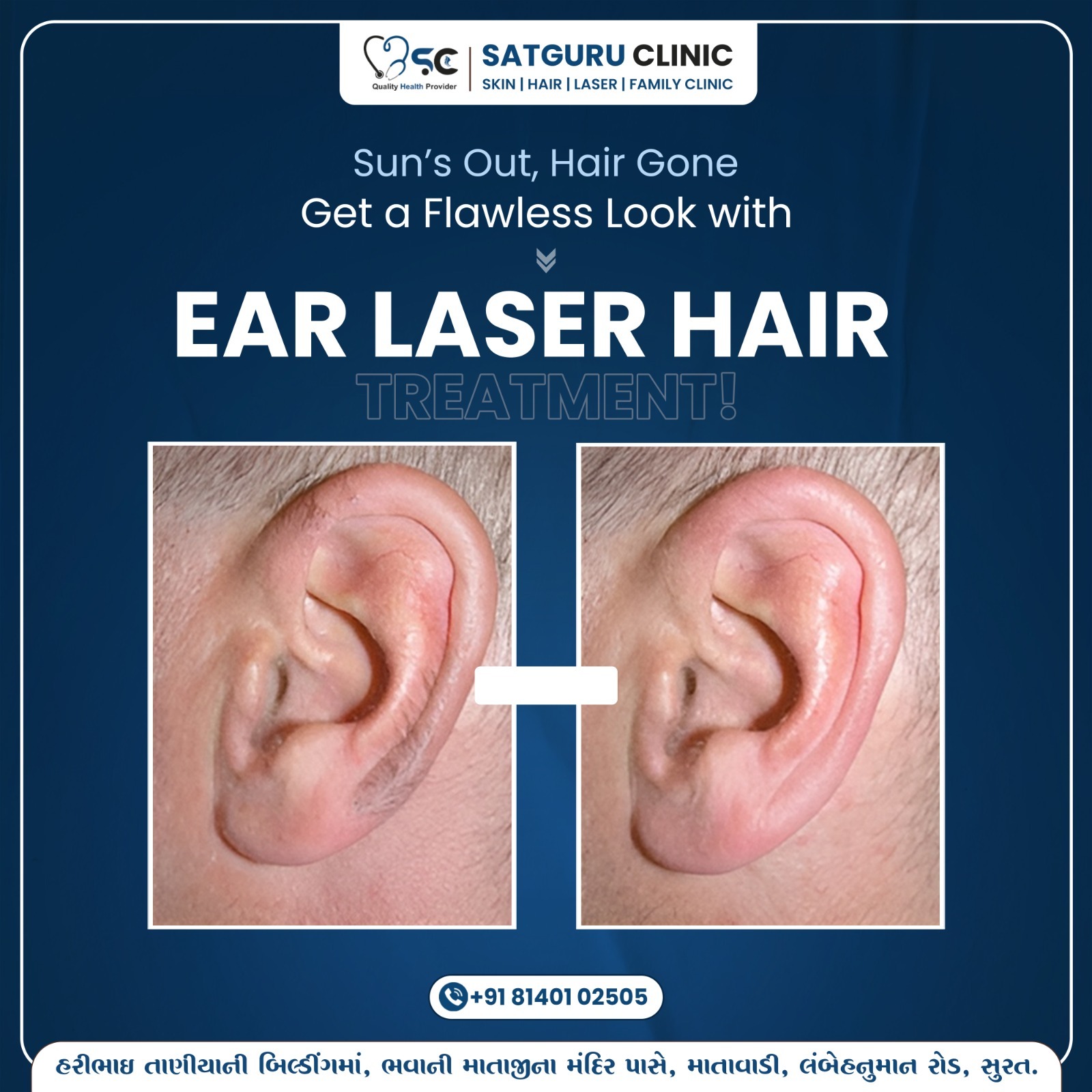 Ear laser hair removal is a safe, non-invasive procedure that uses concentrated light energy to remo... main image