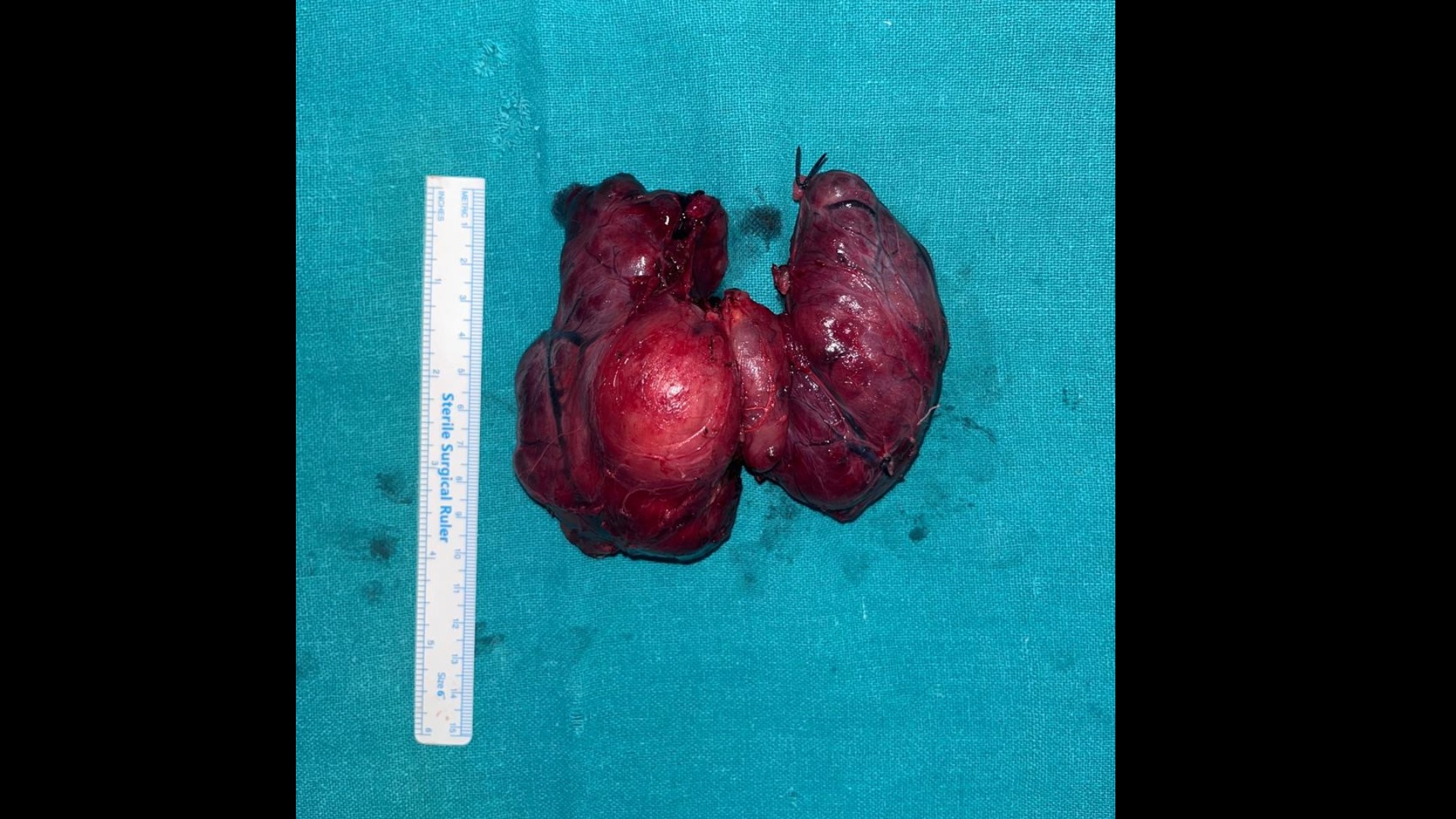 Thyroid Surgery main image