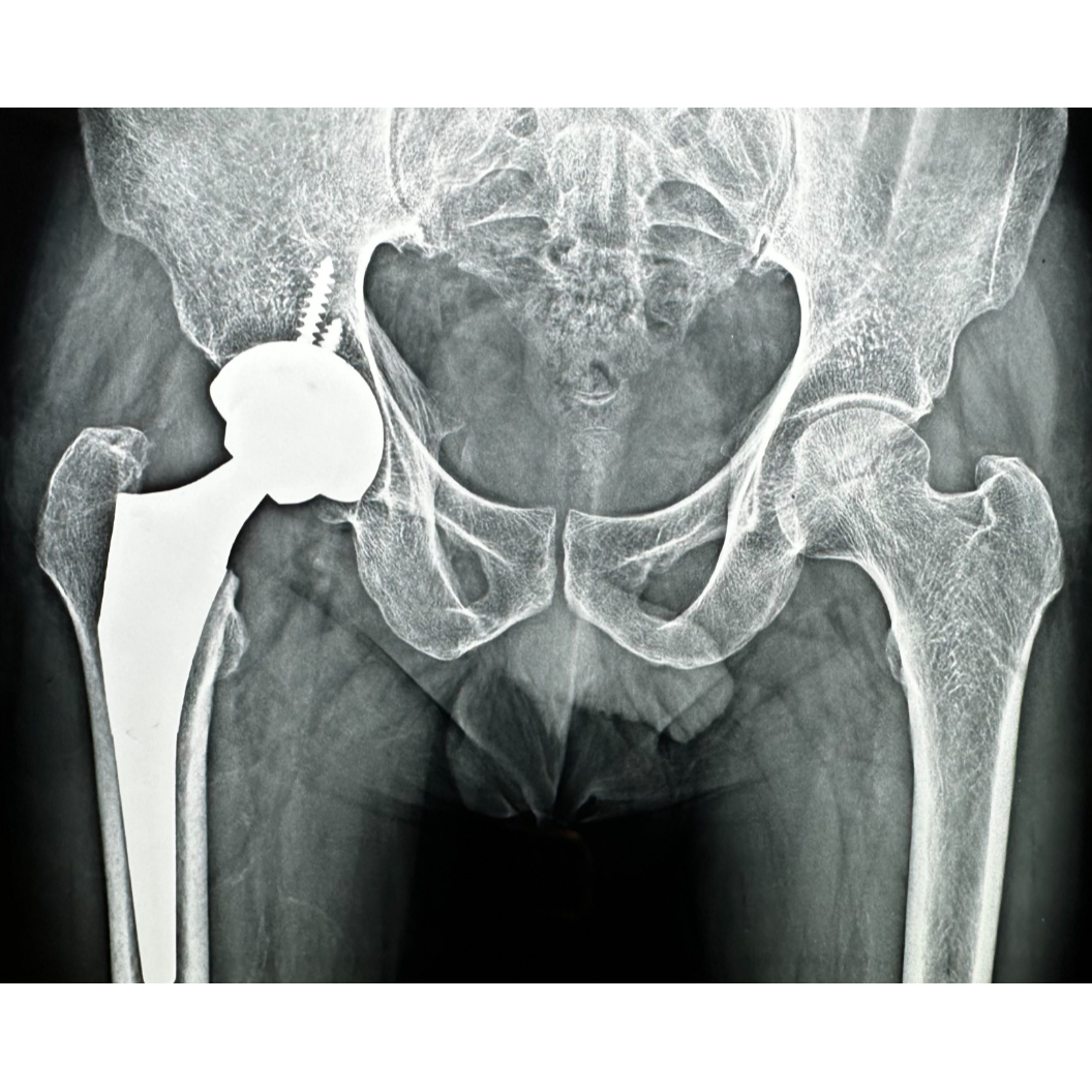 Hip Replacement Surgery in Nagpur main image