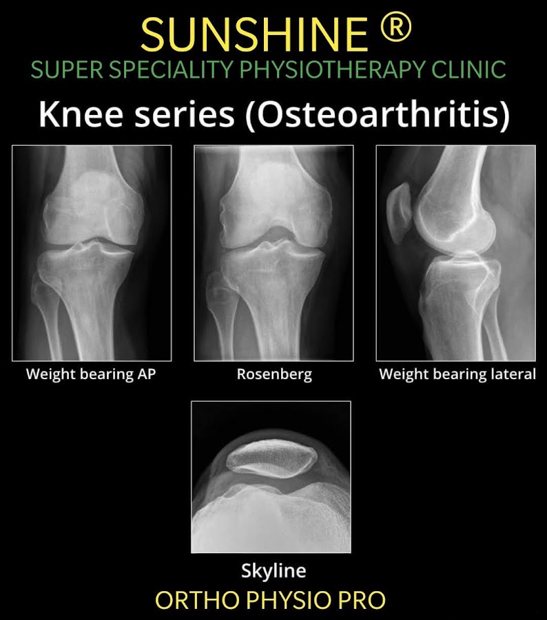 Osteoarthritis knee and Physiotherapy treatment main image