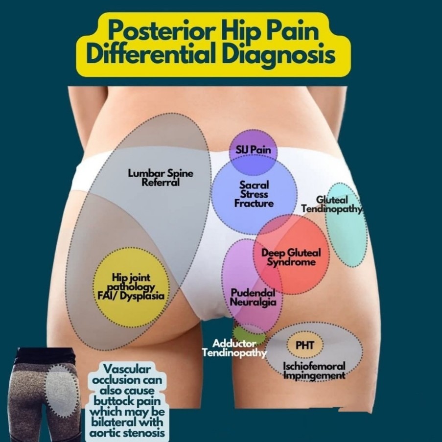 Posterior hip pain is complex and treatment at Sunshine cli... main image