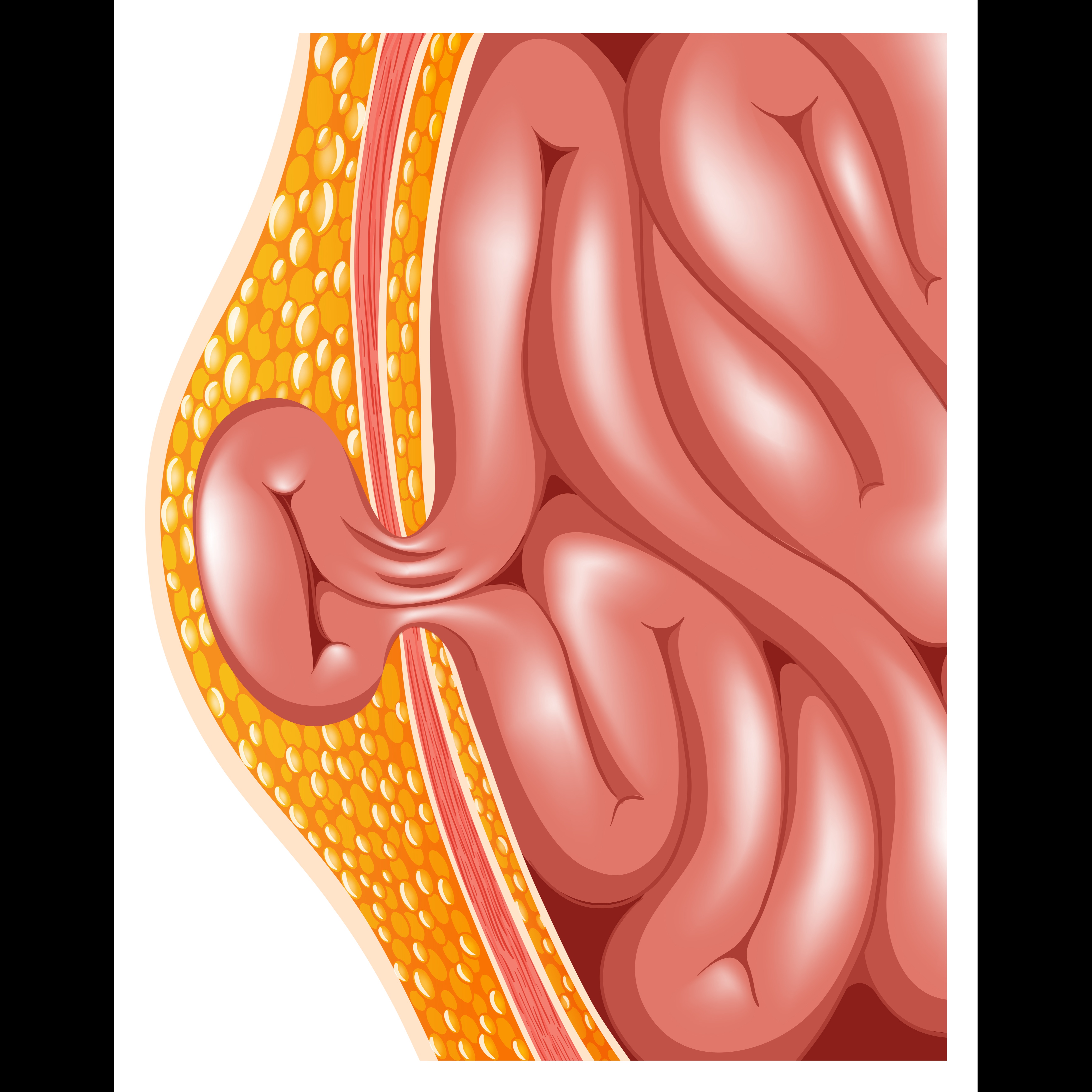 Hernia Treatment in Chennai with Surgical Precis... main image