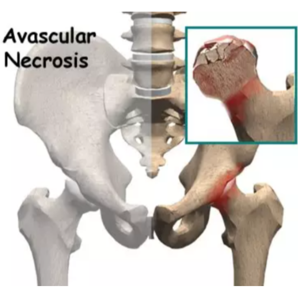 Avascular Necrosis Diagnosis in Nagpur main image
