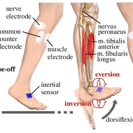 Foot drop treatment at Sunshine clinic main image
