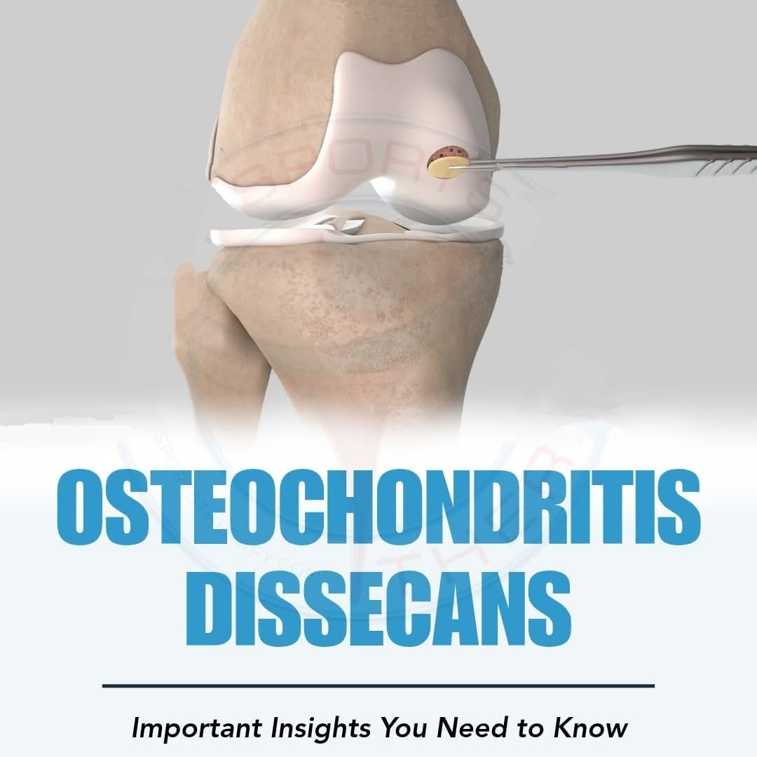 Osteochondritis Dissecans (OCD) main image