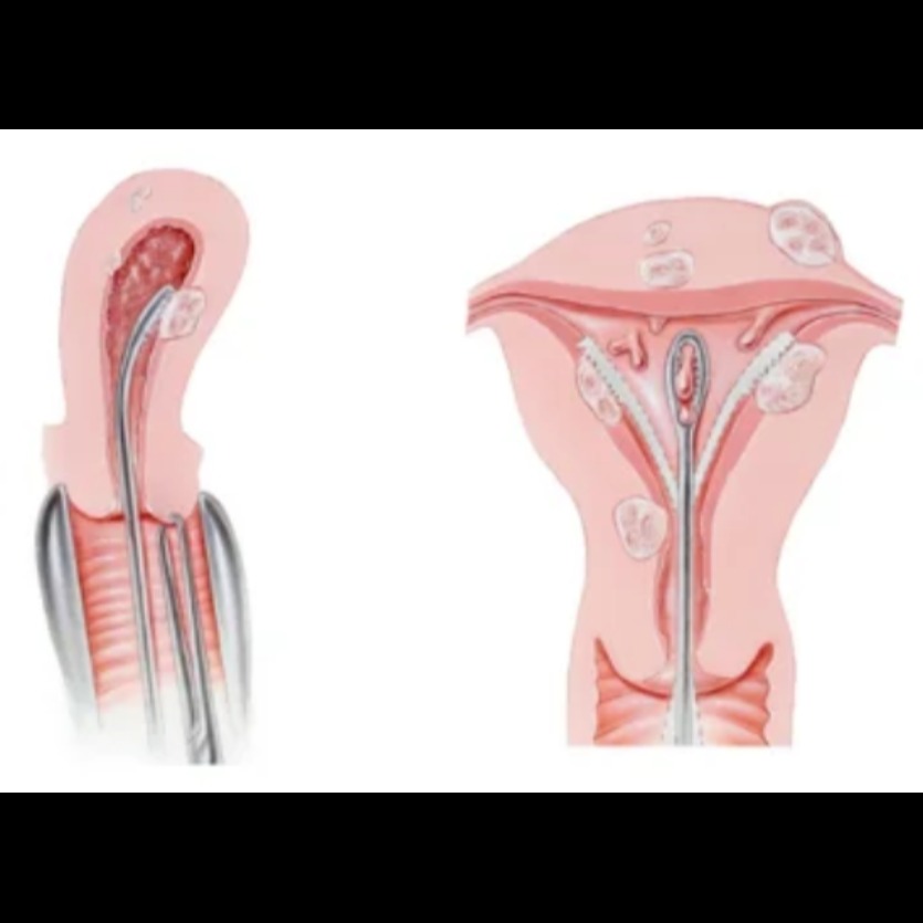 Hysteroscopic Septum Resection in Chennai – A Safe Solution for Better Fertility Outco... main image