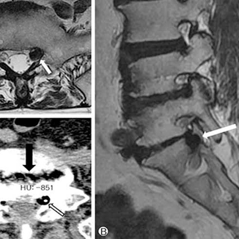vacuum sac on the back of the spine main image