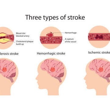 stroke rehabilitation at Sunshine Super Speciality Physiotherapy cli... main image