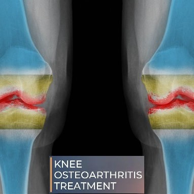 Osteoarthritis knee and treatment at Sunshine Super Speciality Physiotherapy clinic main image